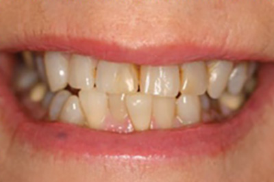 A case with before smile