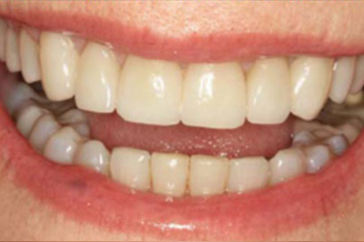 A case with after smile