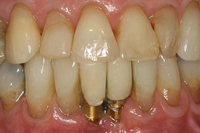 A case with before smile